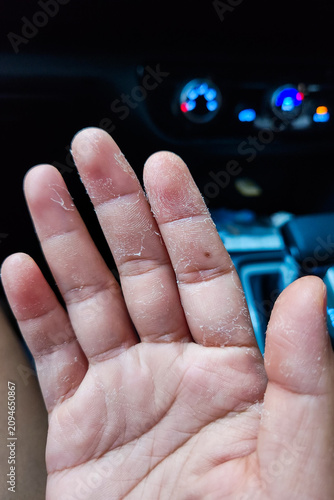 Macro shot of damaged, flaking skin on a human hand, illustrating symptoms of contact dermatitis or an allergic reaction