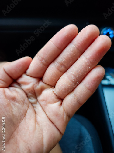 Medical and healthcare concept: close-up view of heavily peeling skin shedding from the fingertips and palm of a woman's hand