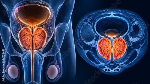 Benign Prostatic Hyperplasia with Enlarged Prostate Gland, Urethral Compression and Lower Urinary Tract Symptoms, Medical Illustration