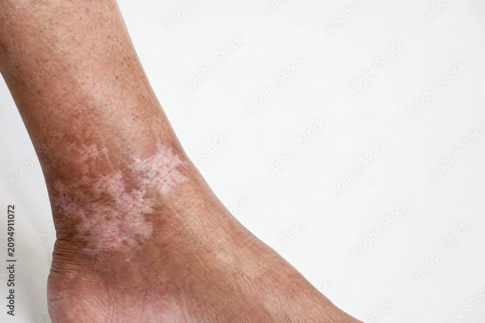 Fototapeta premium Atrophie Blanche on Elderly Asian Woman's Ankle — White Atrophy Skin Condition