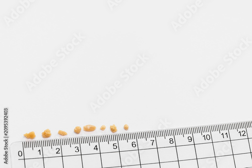 Measuring kidney stones with a ruler for medical measurements and urological documentation.