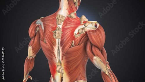 Photos Progressive Soft Tissue Ossification Disorder