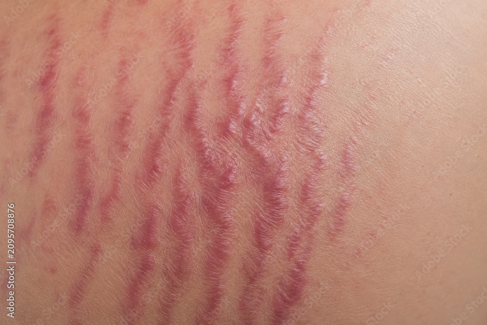 Fototapeta premium Close-up of red stretch marks on light skin showing texture and irregular pattern detail