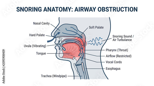 Foto Snoring Anatomy: Airway Obstruction Diagram