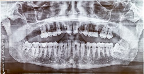 Photos A wide panoramic dental radiograph (OPG), revealing a horizontally impacted lower wisdom tooth and a missing upper molar