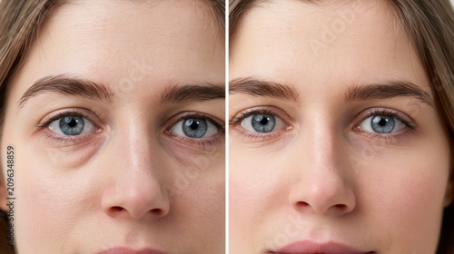Symmetric centered split frame showing bilateral puffy herniated fat bags under both eyes versus flat smooth undereye skin. Concept of undereye bag correction.