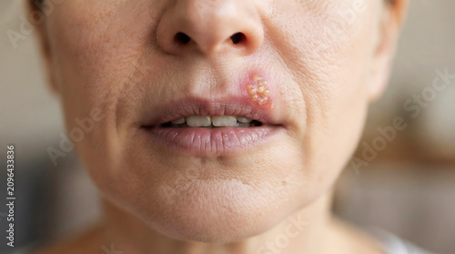 Close-up of person's mouth with cold sore