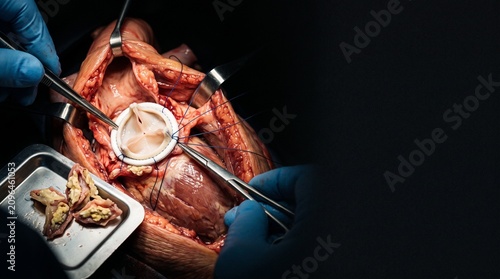 Cardiac Valve Replacement Surgery with Prosthetic Heart Valve Implant During Open Heart Procedure