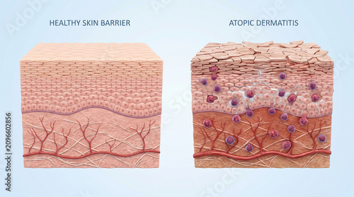 3D Medical Illustration of Healthy Skin Barrier vs Atopic Dermatitis Eczema

