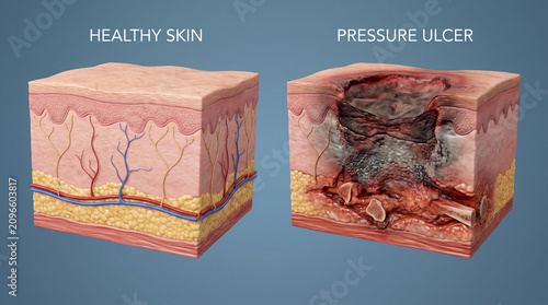 3D Anatomy of Healthy Skin vs Pressure Ulcer Bedsore
