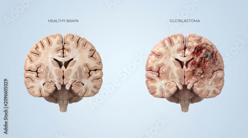 Glioblastoma Brain Tumor and Healthy Brain Cross Section
