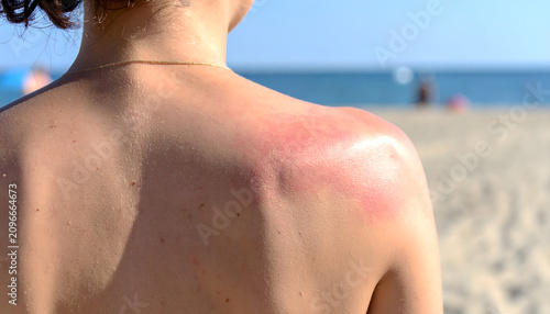 Sunburned skin on a young womans back after spending too much time under the bright summer sun at the beach