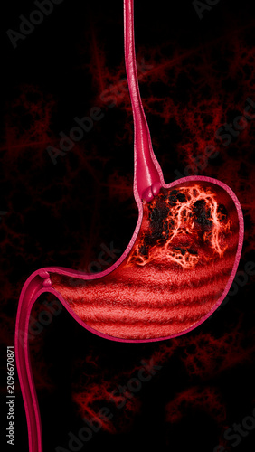 Gastric Carcinoma Inside Human Digestive System Illustrating Tumor Formation and Tissue Damage 3D Rendering