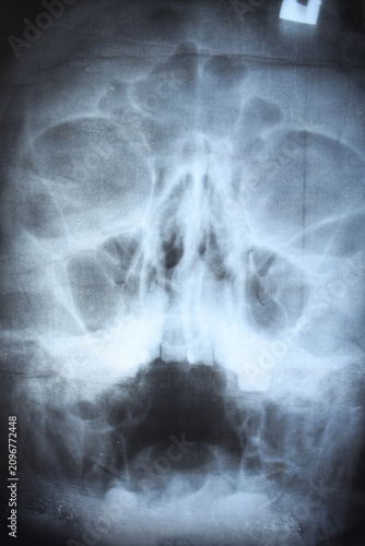 X-ray image of human skull,...