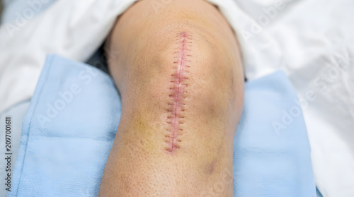 Close up of a stitched surgical knee scar.