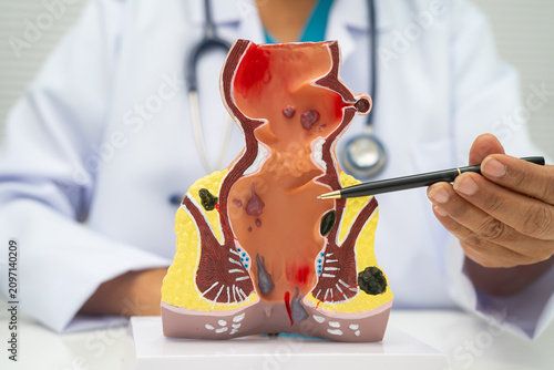 фотографія Asian doctor with rectum and hemorrhoid human model, inflamed vascular structure
