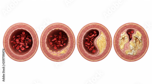 Medical illustration showing the progression of atherosclerosis with plaque buildup narrowing the human artery and restricting blood flow