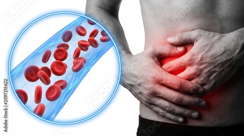 Cyclosporiasis disease outbreak as a foodborne parasitic illness caused by Cyclospora cayetanensis as an outbreak with contaminated food or water resulting in explosive diarrhea and digestive illness.