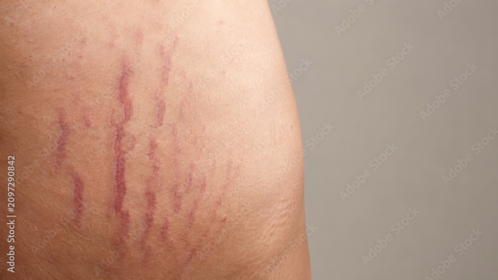Fototapeta premium Close up of red stretch mark on smooth skin showing natural skin condition detail and texture