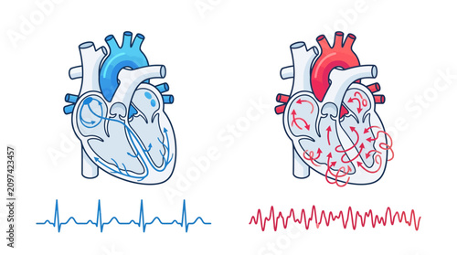 Human Heart Rhythm Comparison featuring anatomical diagrams of normal sinus rhythm versus atrial fibrillation with EKG waves, ideal for medical education and cardiology presentations.