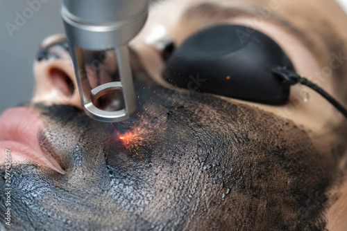 Woman receiving laser carbon facial treatment in cosmetology clinic. Cosmetologist using professional device to remove black mask for skin rejuvenation. Dermatological skincare procedure.