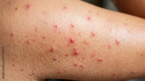 Close-up of inflamed skin with red bumps and scabs