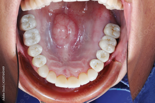 Tableau sur toile Intraoral macro photography of palatal torus bony growth on the maxilla hard palate