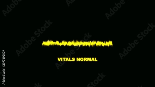 Medical Heart Rate Monitor Showing Vitals Normal Waveform Transitioning To A Flat Red Line On Black Background