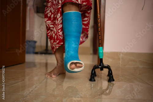 Broken leg
