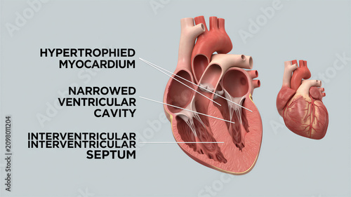 Visualizing the anatomical changes in hypertrophic cardiomyopathy affecting heart chambers