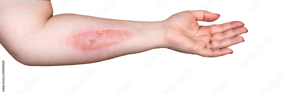 Fototapeta premium Burn on female arm skin close up macro isolated on white background.
