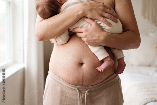 Mother holding her newborn baby against her postpartum belly with a visible cesarean section scar