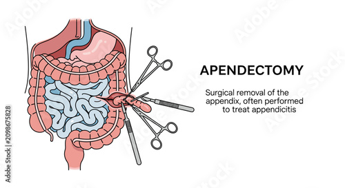 Medical illustration of an appendectomy procedure, showing surgical instruments removing the appendix from the human digestive system, with explanatory text.