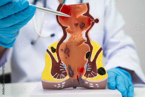 Photography Asian doctor with rectum and hemorrhoid human anatomy model at hospital, inflamed vascular structure