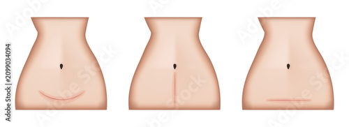 Woman body showing different types of cesarean section scars