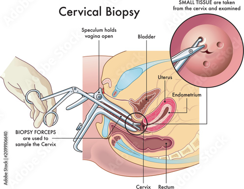 Medical illustration  of the cervical biopsy procedure with annotations.