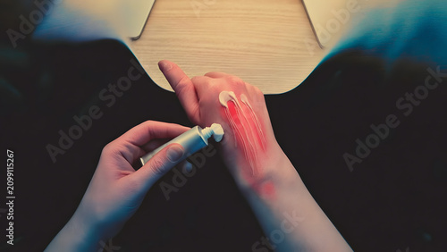 Applying soothing white medical cream from a tube onto red irritated skin on hand, treatment of eczema, burn, allergic rash or dry skin, skincare and dermatology concept