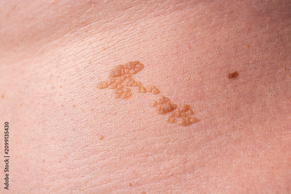 Fototapeta premium Close Up of Raised Skin Lesion