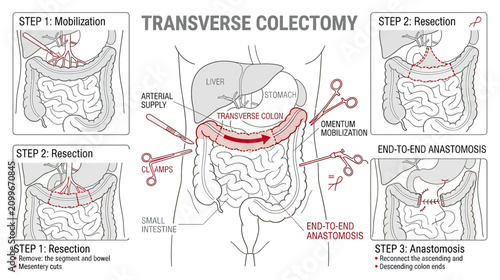 Obraz na płótnie Transverse Colectomy Surgical Procedure Illustration