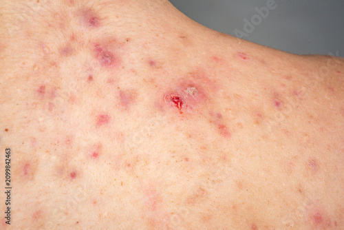 Acne pimple with infected pore. Acne pimple and bacterial inflammation. Human skin detail, acne pimple. Medical macro, acne pimple problem.