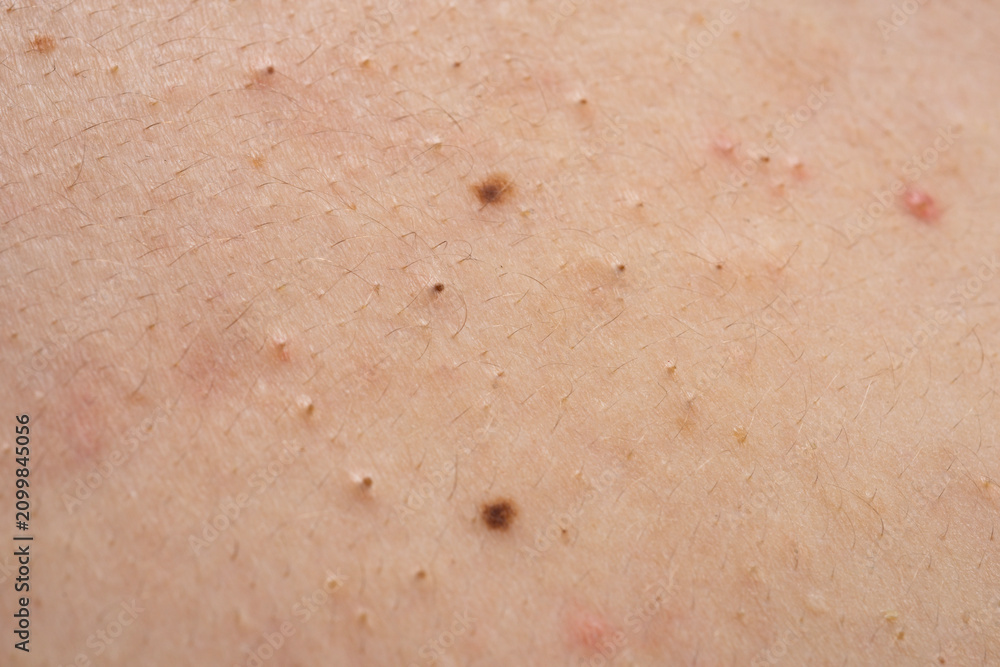 Fototapeta premium Blemishes on acne skin texture. Blemishes with inflamed pimples redness. Blemishes near pores and lesions. Blemishes in dermatology closeup detail.