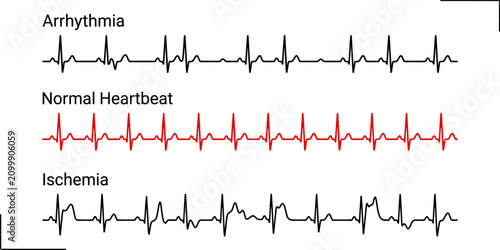 Cuadro en lienzo ECG Line Vector Set - Normal Heartbeat, Arrhythmia, and Cardiac Ischemia Electro