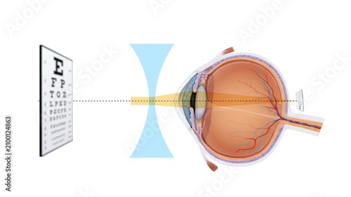Myopia Eye Correction Medical Animation Nearsighted Vision, Concave Lens Optics, Human Eye Structure, Vision Care, Ophthalmology Training, 2D and 3D Educational Animation