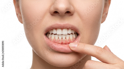 Close up of advanced gum recession exposing lower front tooth roots isolated on white background for periodontal healthcare awareness and professional dental education