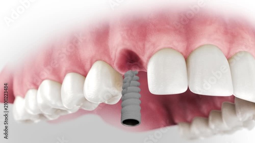 3D visualization of a dental implant: a two-piece screw-retained crown where the abutment is connected and then the screw connects the crown to the abutment.