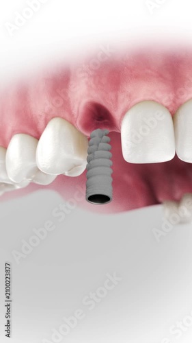 3D visualization of a dental implant with one-piece screw-retained crown placement.