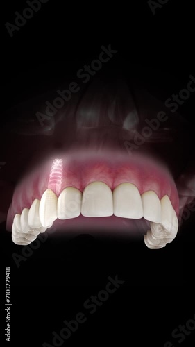 3D visualization of a dental implant of a maxillary canine with a transparent crown and visible gum anatomy on a black background.