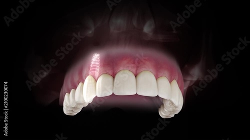 3D visualization of a dental implant of a maxillary canine with a transparent crown and visible gum anatomy on a black background.