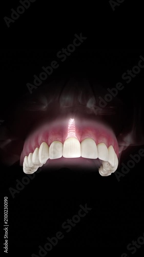 3D visualization of a dental implant of a maxillary central incisor with a transparent crown and visible gum anatomy on a black background.
