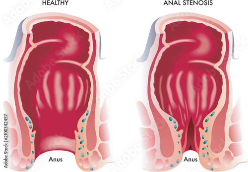 Medical illustration shows a normal anus and one with stenosis